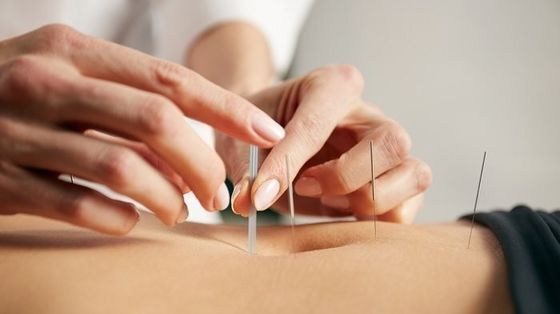 銀皮内鍼 - 美容および医療用途のプロフェッショナルチョイス